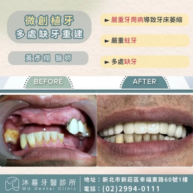 微創植牙重建多處缺牙
