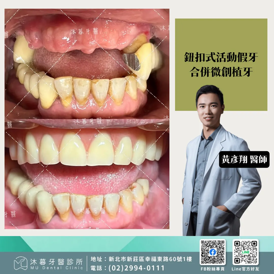 鈕扣式活動假牙合併微創植牙
