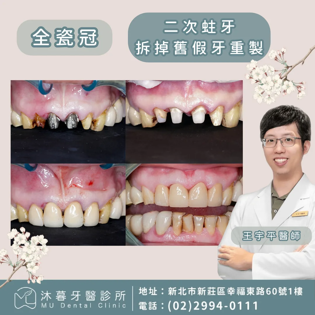 二次蛀牙，拆除舊假牙重製