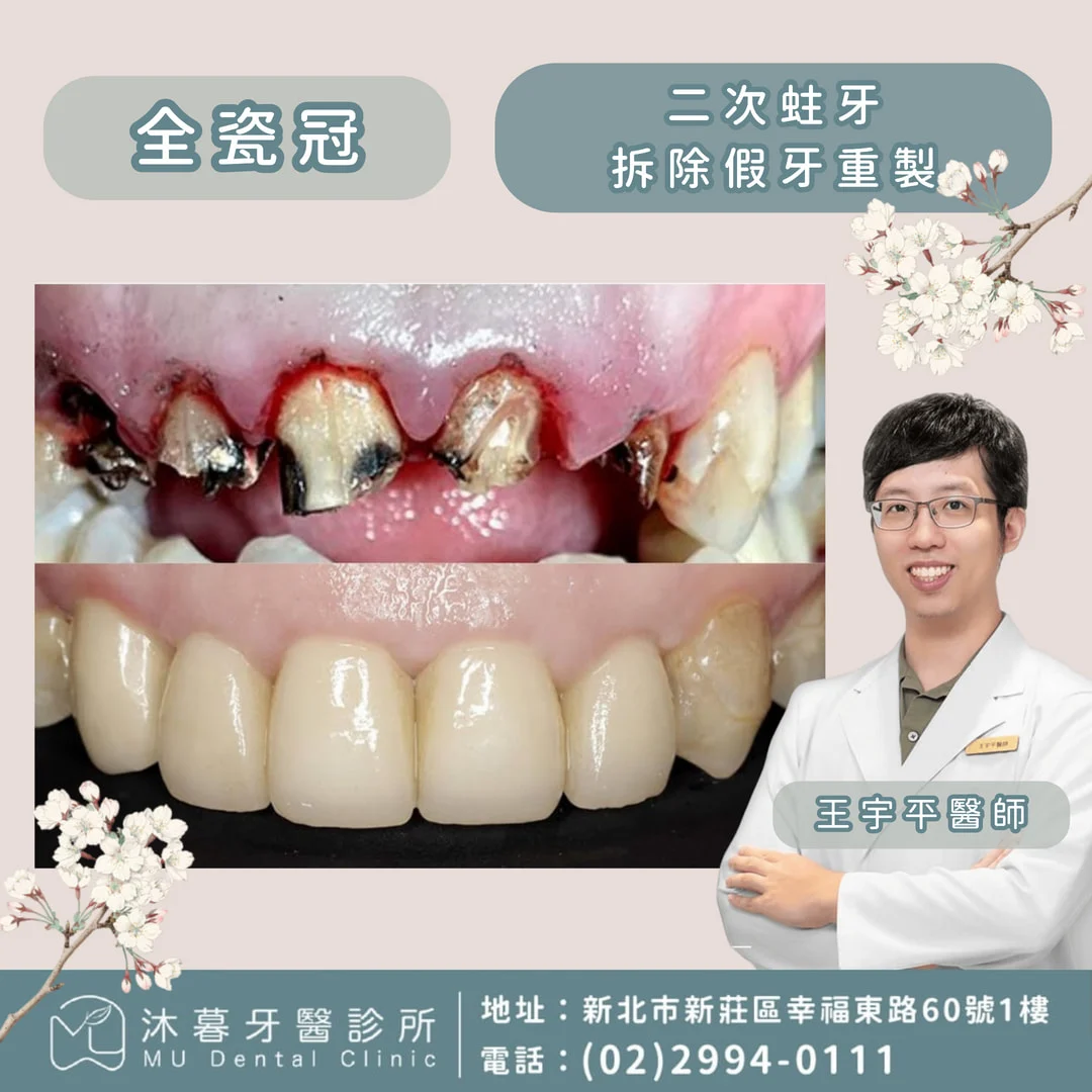 二次蛀牙，假牙重製