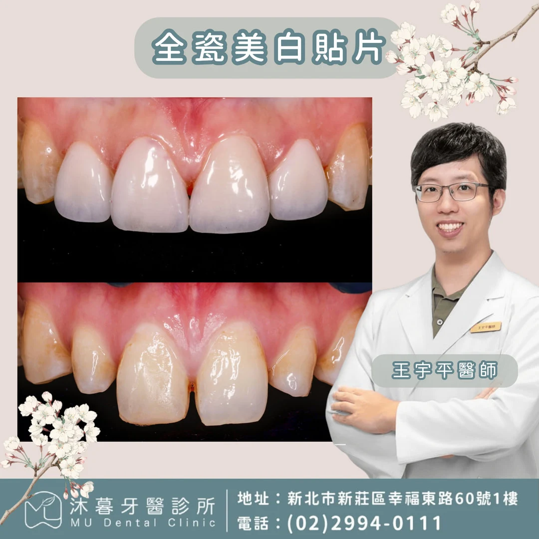 全瓷美白貼片-牙齒縫隙明顯及外型調整