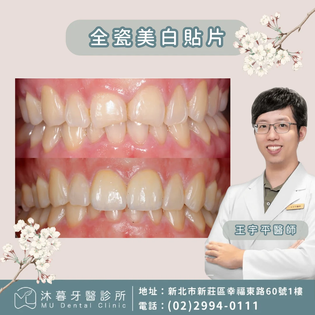 門牙斷裂 全瓷美白貼片重建
