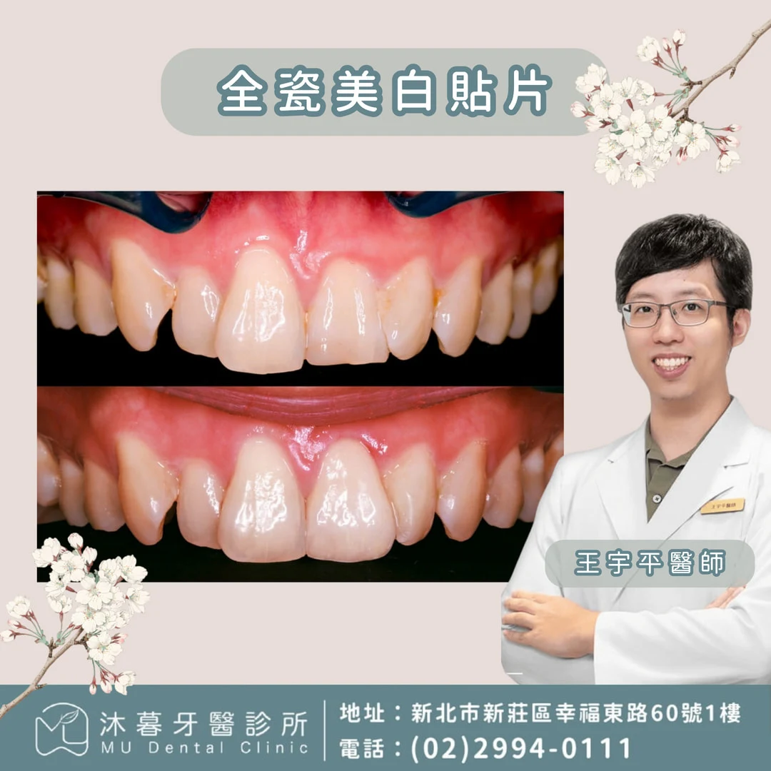 門齒牙冠斷裂-美白貼片重建