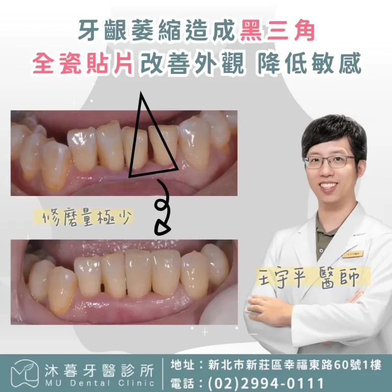 全瓷貼片改善牙齦萎縮黑三角